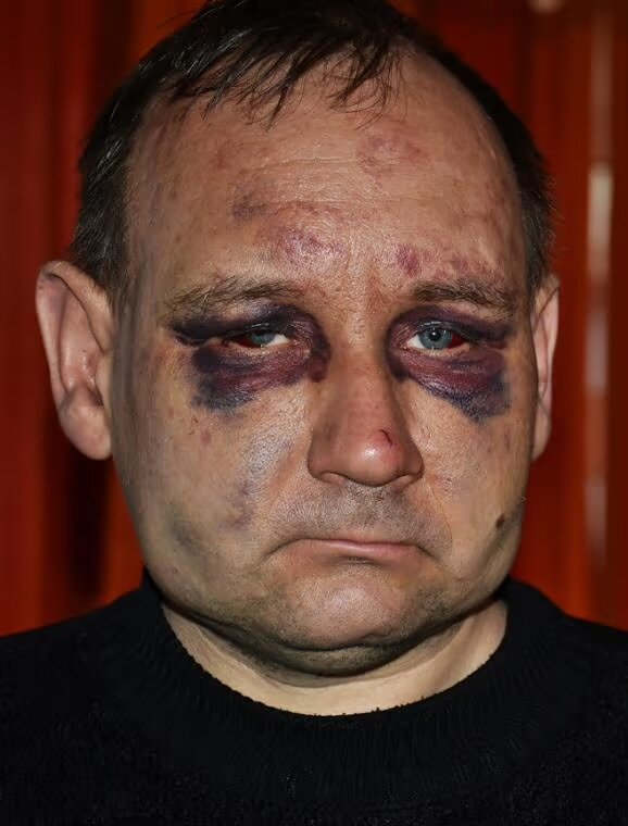 Олександру Вовк після побиття в Донецькій ОДА
