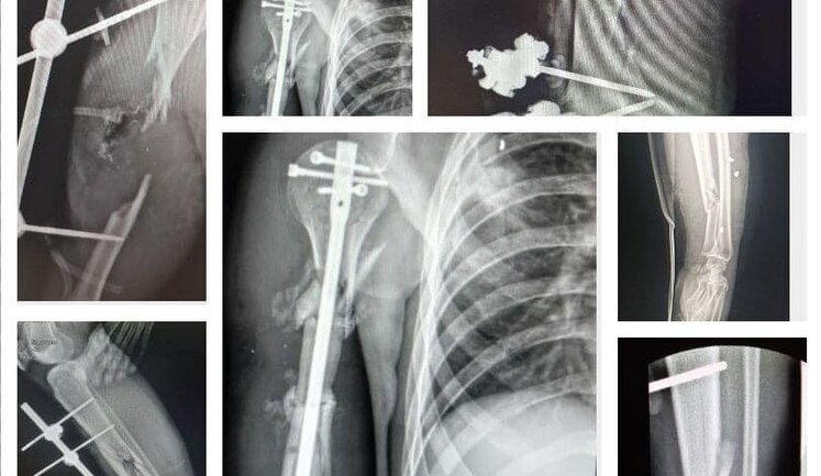 Благотворительный проект "На Шапку": украинские музыканты собрали деньги на 153 костных импланта для раненых военных, - радиоведущая Сотник. ФОТО