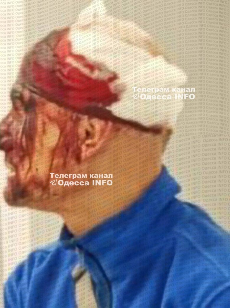 ТЦК в Одесі прокоментував фото чоловіка з травмою голови