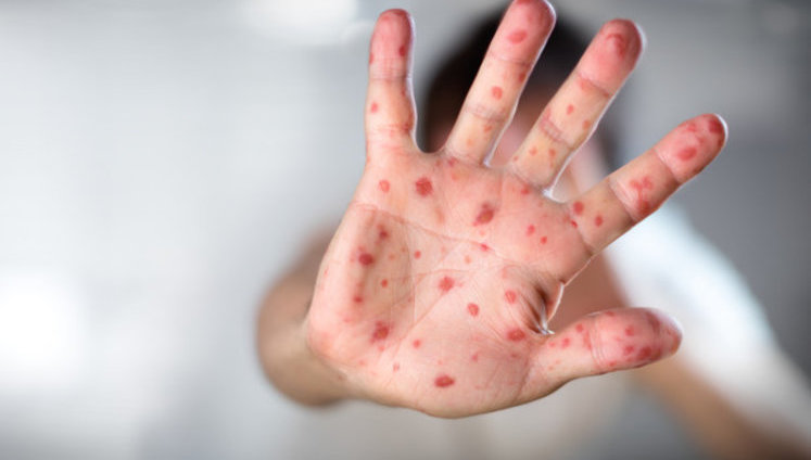 Непривитых от кори детей не будут пускать в детсады и школы в Ивано-Франковской, Одесской и Тернопольской областях, - Минздрав