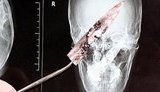 Китайская закалка: четыре года с ножом в голове. Не для впечатлительных. ФОТОрепортаж