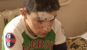На Днепропетровщине двое школьников пострадали от взрыва петарды