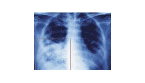 Медики поняли, почему грипп поражает легкие