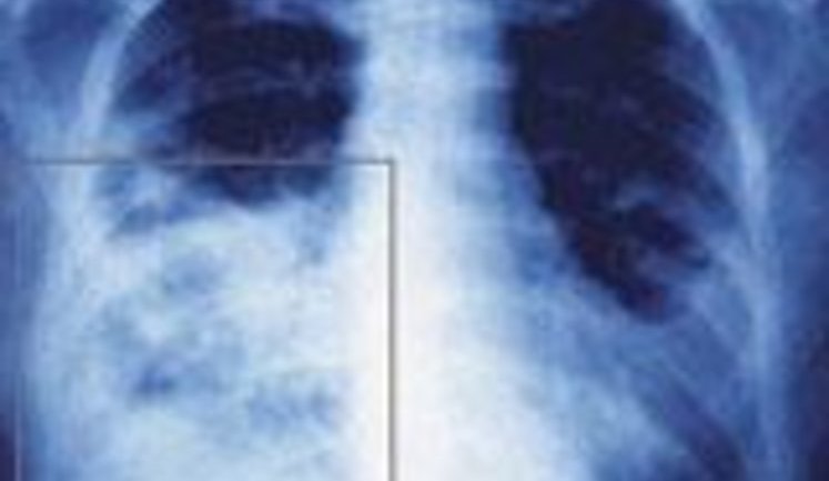 Медики поняли, почему грипп поражает легкие