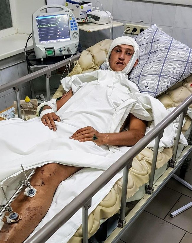 Поживемо ще, - кіборг Віктор, який дивом вижив у бою за ДАП, успішно переніс операцію після важкої ДТП 01