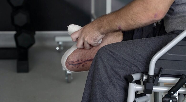 Сергій Дикун, який втратив ногу на війні: Думаю, я в армії ще пригоджусь. Ампутація в мене ще не дуже велика - одна нога...Десь пригоджусь в армії 01