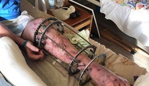 До Києва прибув новий борт: у реанімації лежать тяжкопоранені воїни, - волонтерка Юсупова просить українців про допомогу в лікуванні українських бійців. ФОТОрепортаж
