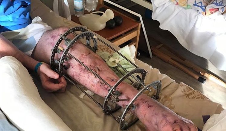 До Києва прибув новий борт: у реанімації лежать тяжкопоранені воїни, - волонтерка Юсупова просить українців про допомогу в лікуванні українських бійців. ФОТОрепортаж