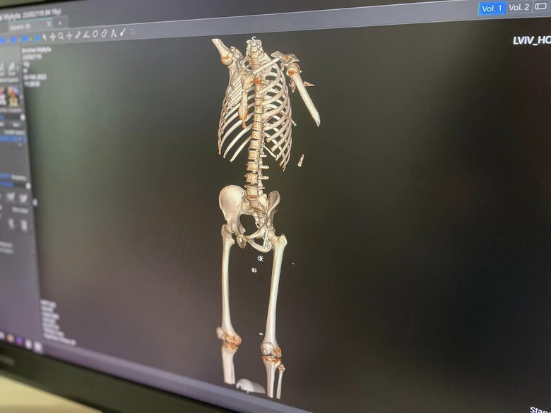 Doctors saved teenager from Bakhmut, who had fragment of projectile stuck near his heart 04 Doctors saved teenager from Bakhmut, who had fragment of projectile stuck near his heart 04