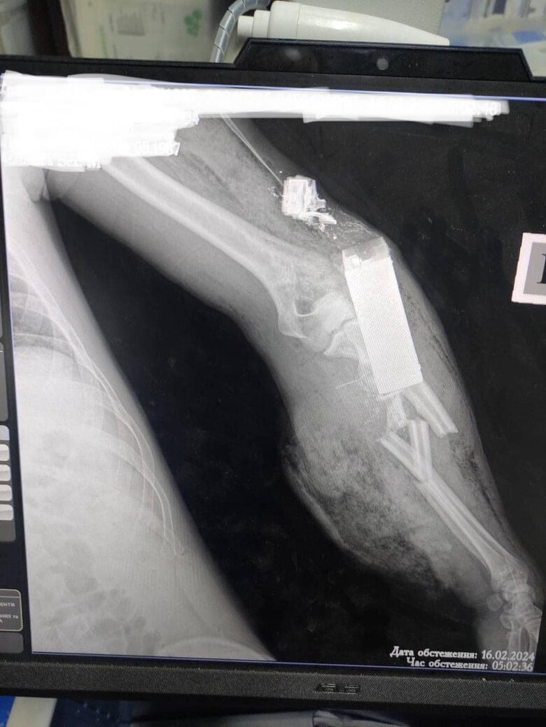 ВОГ-17 у руці пораненого військового