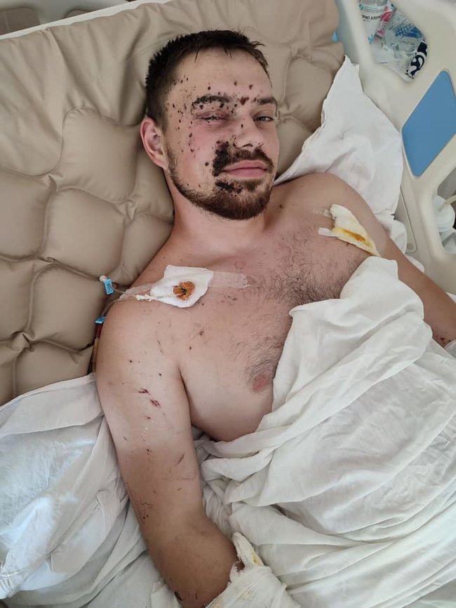 Пораненому під час виконання бойового завдання на Донбасі комвзводу 54-го ОРБ Борису Бассу потрібна допомога в лікуванні та реабілітації, - волонтерка Самойлова 02