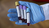 13 more coronavirus cases observed in Chernivtsi region