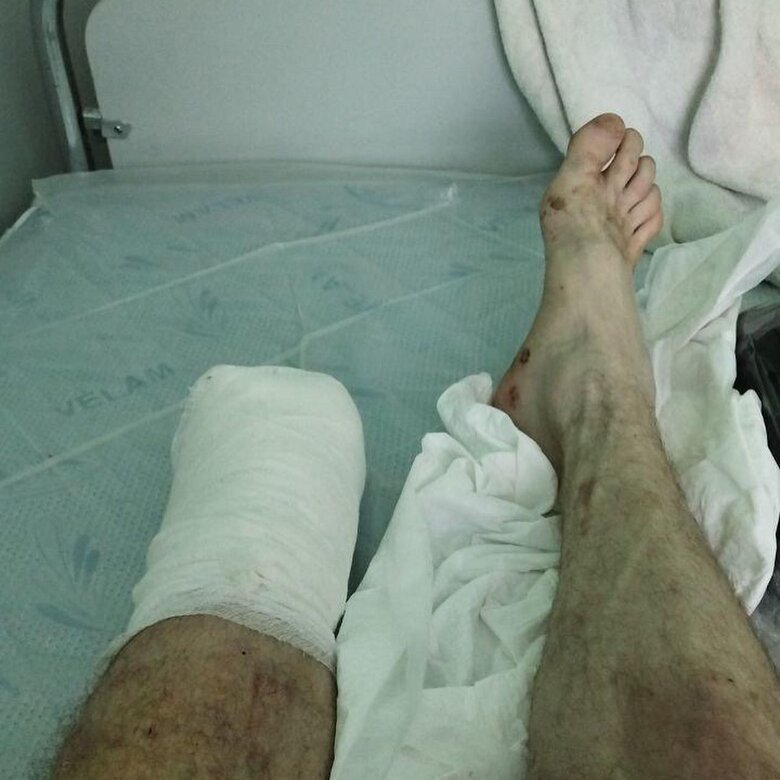 Українському воїну Сергію Дзюбановському, який втратив ногу на бойовому завданні, потрібна допомога у придбанні протезу 04