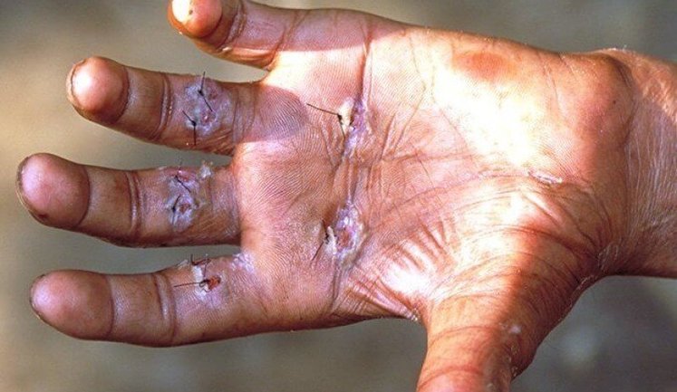 Впервые за 40 лет: в соседней с Украиной Румынии обнаружили проказу