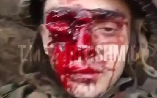 "Теперь я пират одноглазый. Я в аху#", - скиглить рашист після невдалого штурму. ВIДЕО 18+