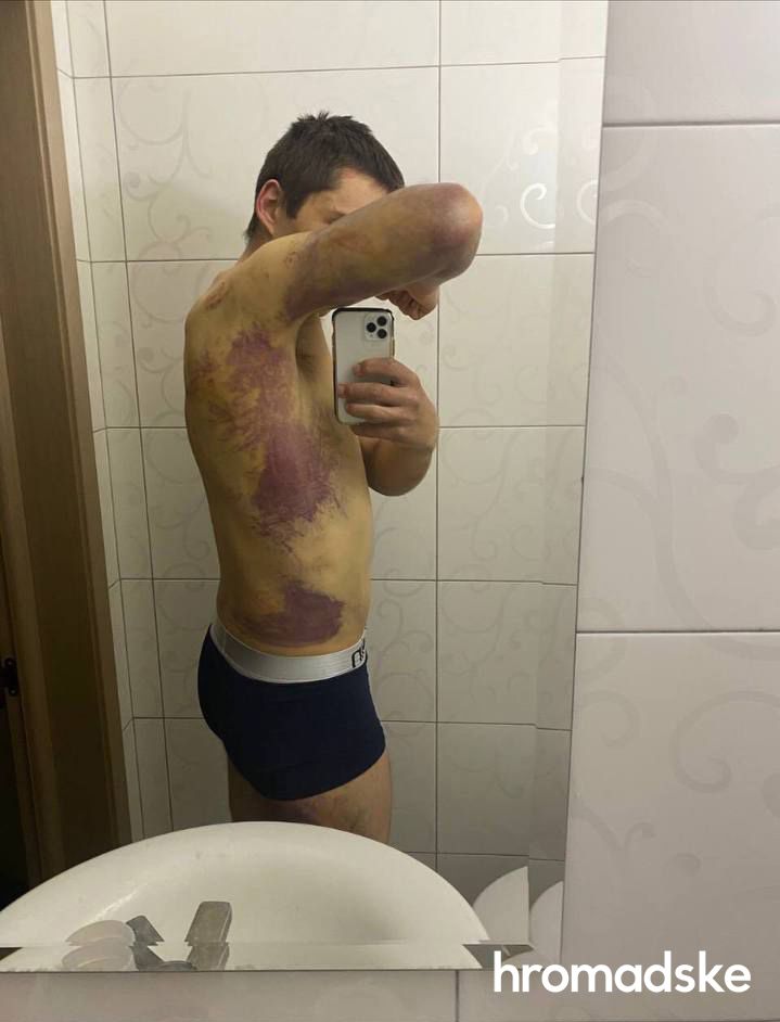 Мы лежали в крови, другой мужчина еще и в фекалиях. Я попросил воды. Не дали: житель Казачьей Лопани рассказал о пытках, которые пережил в плену оккупантов 04