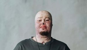 "Потерял старого себя, но создаю нового". История ветерана Егора Бабенко, получившего тяжелые ожоги на войне. ВИДЕО+ФОТОрепортаж