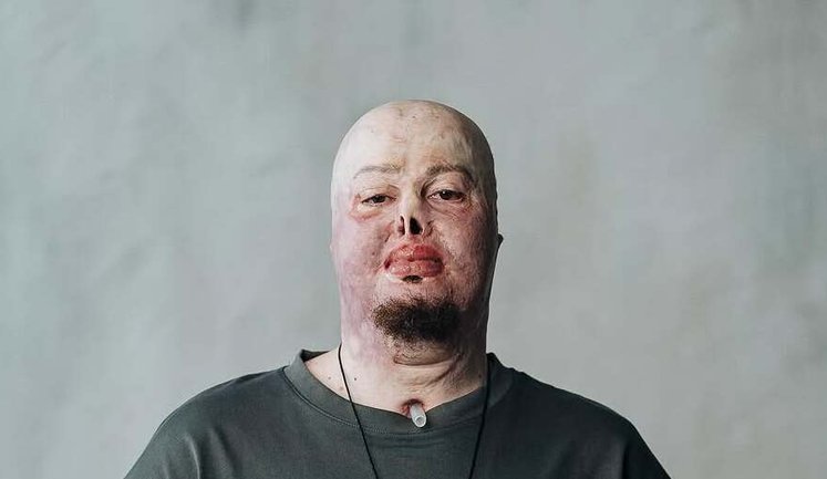 "Потерял старого себя, но создаю нового". История ветерана Егора Бабенко, получившего тяжелые ожоги на войне. ВИДЕО+ФОТОрепортаж