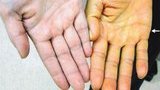 На початок року в Україні зареєстровано понад 7,1 тис. нових випадків гепатиту С, загалом інфіковано 1,3 млн громадян, - ЦГЗ