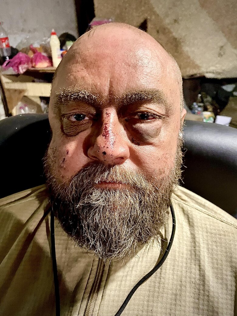 Український воїн після зустрічі з ворожим безпілотником: основний заряд ударив у бронежилет 01