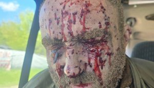 Важкопораненому українському воїну потрібна екстрена операція на очах. Оголошено збір коштів. ФОТО