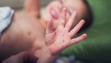 Спалах кору в Одеській області: в селі Шевченкове захворіли вже 48 дітей, батьки з релігійних переконань відмовлялися їх прищеплювати