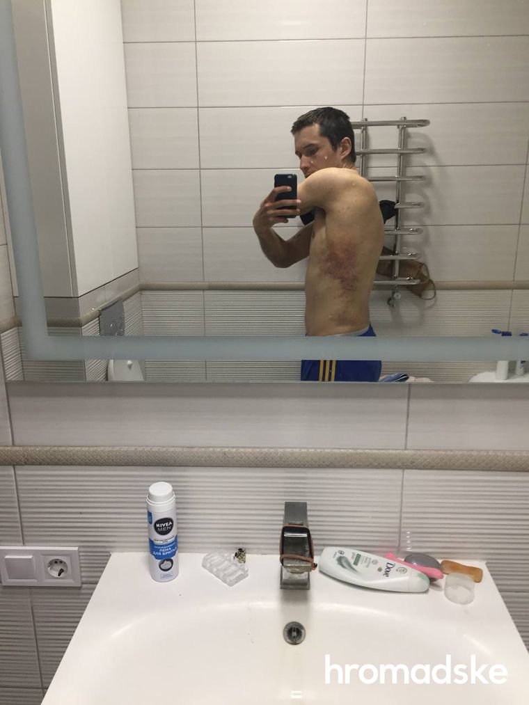 Мы лежали в крови, другой мужчина еще и в фекалиях. Я попросил воды. Не дали: житель Казачьей Лопани рассказал о пытках, которые пережил в плену оккупантов 02