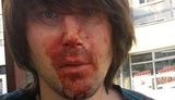 Киевские маршрутки небезопасны: на 45-м маршруте ограбили и избили фотокорра, водитель помог "гопникам" скрыться. ФОТОрепортаж