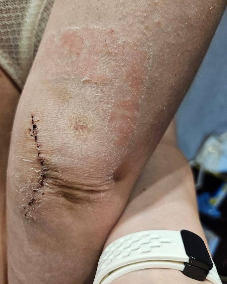 Побита в харківському ТЦК адвокатка отримала інвалідність