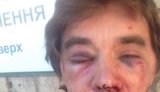 Тітушки у Вишневому жорстоко побили активіста Гришачова, який бореться із забудовою міського парку. ФОТО