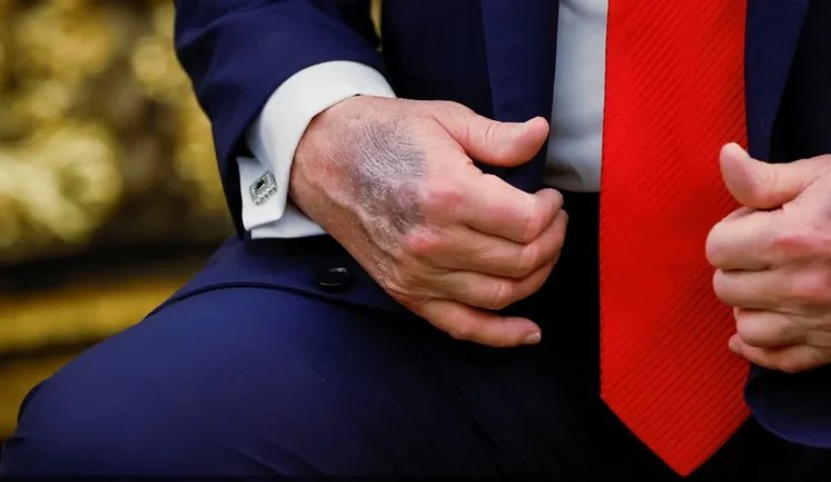 Белый дом прокомментировал пластырь на руке Трампа