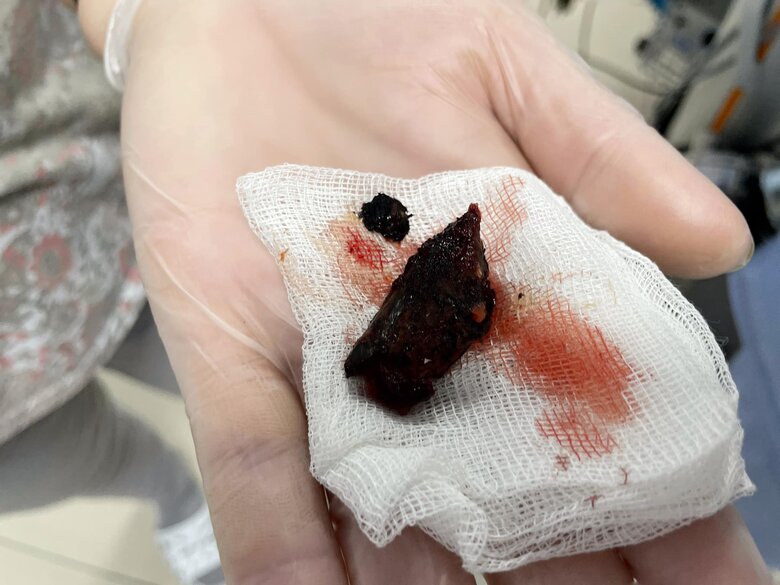 Doctors saved teenager from Bakhmut, who had fragment of projectile stuck near his heart 07 Doctors saved teenager from Bakhmut, who had fragment of projectile stuck near his heart 07