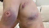 Житель Минска показал причиненные ОМОНом увечья: "Били ногами, дубинками, щитами. Мысленно прощался с семьей". ФОТОрепортаж