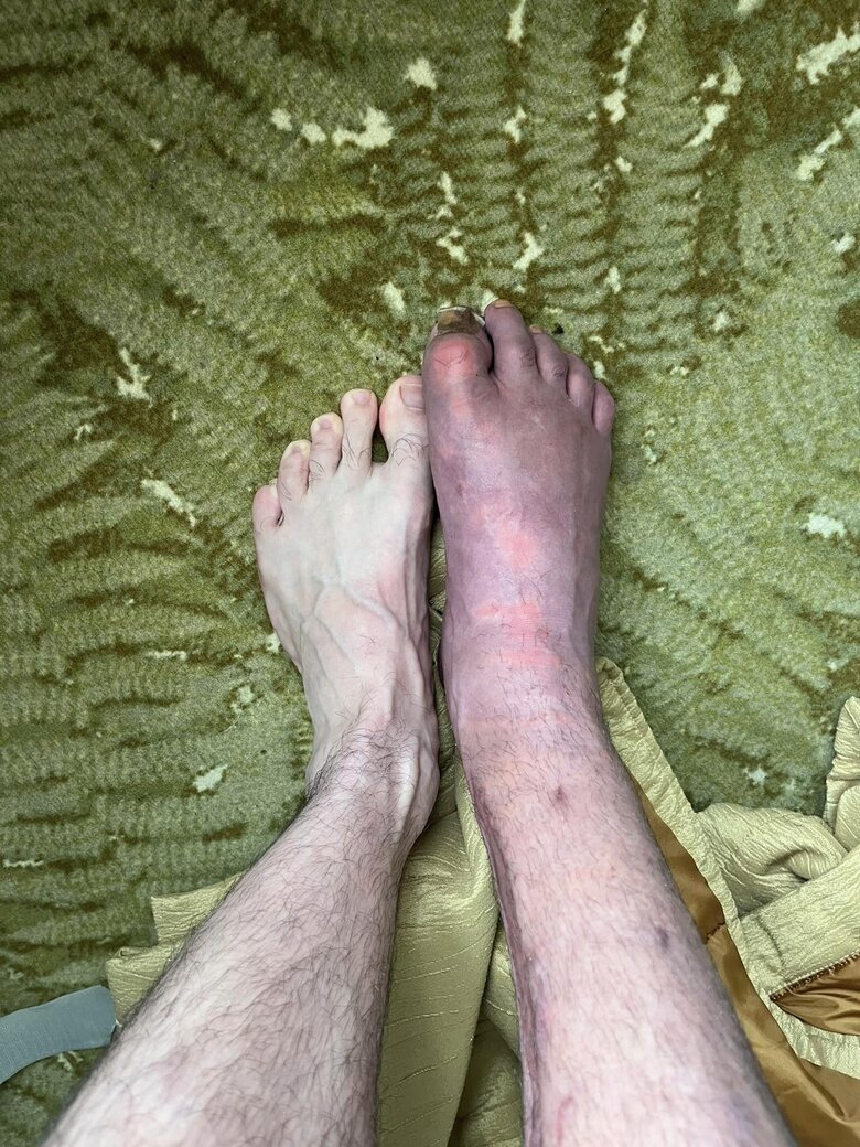 Минздрав проведет проверку решений Харьковской областной МСЭК об установлении инвалидности после жалобы ветерана на совет от главы комиссии отрезать ногу, чтобы получить группу 01 Минздрав проведет проверку решений Харьковской областной МСЭК об установлении инвалидности после жалобы ветерана на совет от главы комиссии отрезать ногу, чтобы получить группу 01