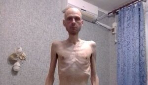 Volodymyr Tsema-Bursov, liberated soldier of 56th Brigade, lost 38 kg in 20 months of captivity and got "bunch" of diseases. PHOTO