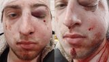Розслідування справи про напад на журналіста "Обозревателя" Грушу поставили на контроль, - заступник голови Нацполіції Цуцкірідзе