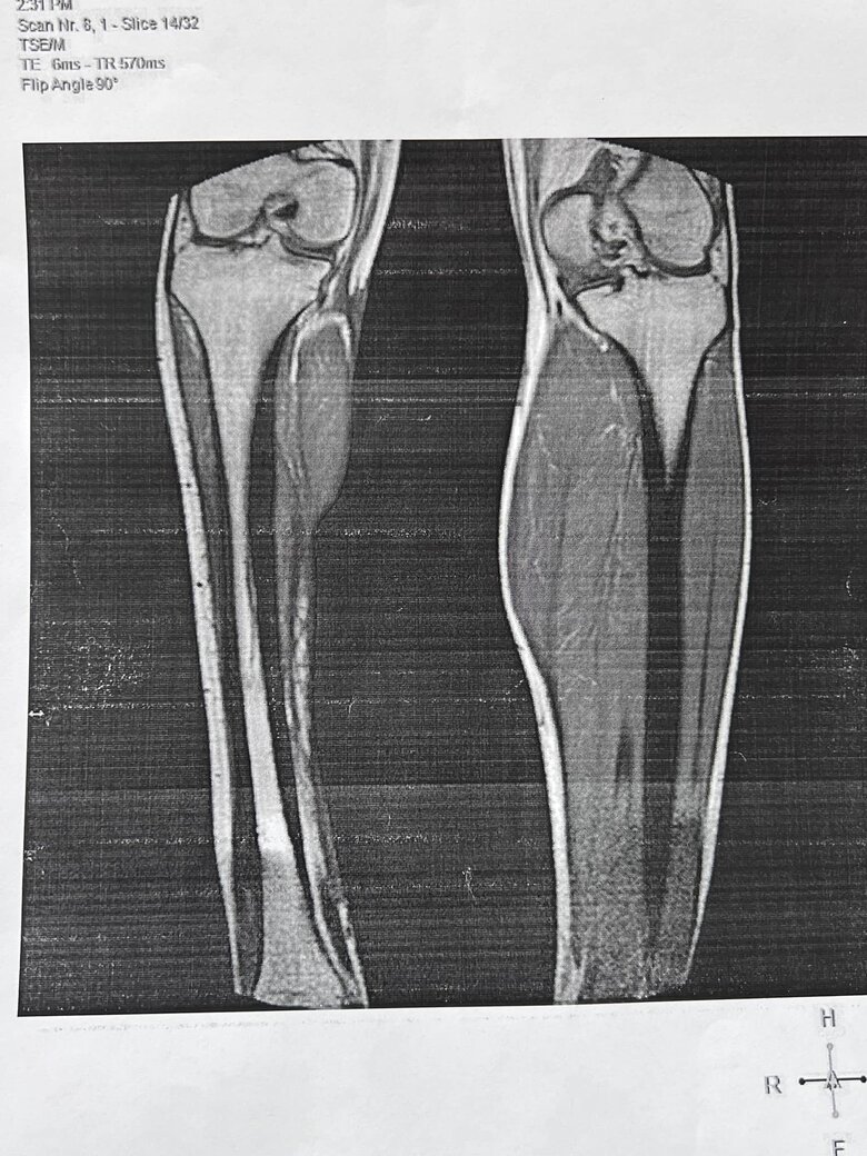 Минздрав проведет проверку решений Харьковской областной МСЭК об установлении инвалидности после жалобы ветерана на совет от главы комиссии отрезать ногу, чтобы получить группу 02 Минздрав проведет проверку решений Харьковской областной МСЭК об установлении инвалидности после жалобы ветерана на совет от главы комиссии отрезать ногу, чтобы получить группу 02