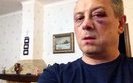 Bruised Face and Concussion: Udar Deputy Severely Beaten Near Kyiv