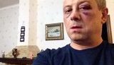 Bruised Face and Concussion: Udar Deputy Severely Beaten Near Kyiv