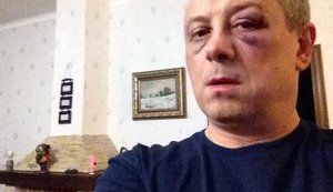Bruised Face and Concussion: Udar Deputy Severely Beaten Near Kyiv