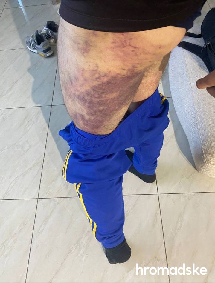 Мы лежали в крови, другой мужчина еще и в фекалиях. Я попросил воды. Не дали: житель Казачьей Лопани рассказал о пытках, которые пережил в плену оккупантов 03