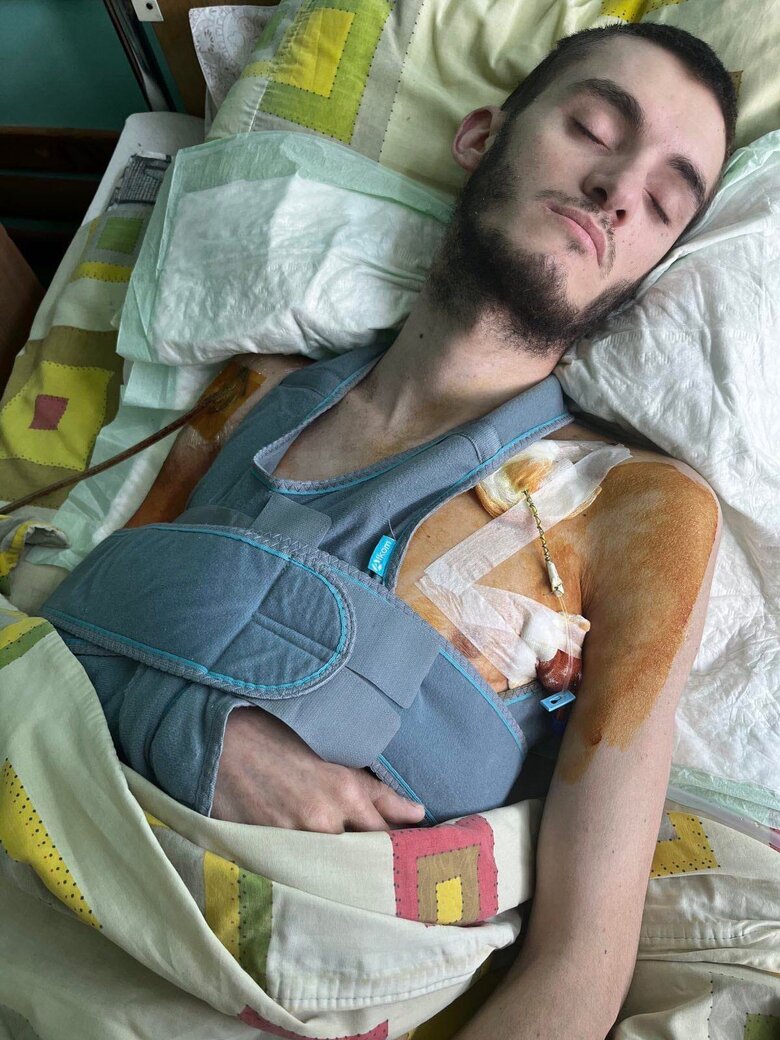 Важко пораненому воїну 57-ї ОМПБр Антону Вишневському потрібна допомога 02