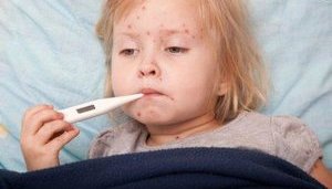 Як захистити себе від кору, - інструкція МОЗ та ЮНІСЕФ