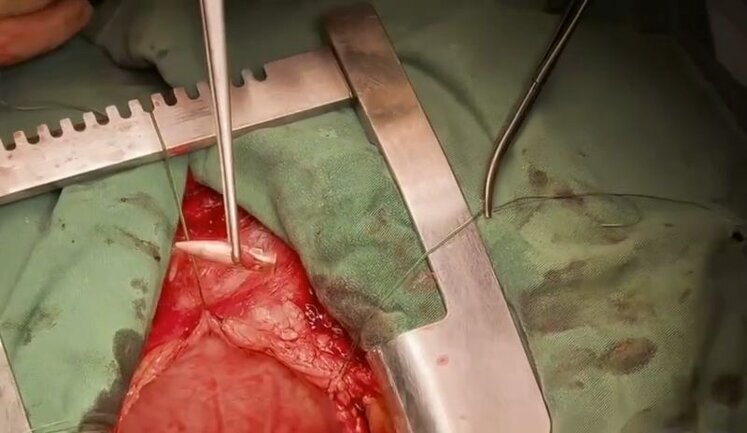 Cardiac surgeon removed bullet from wounded soldier’s heart. VIDEO 18+