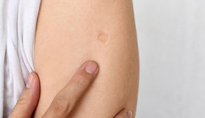 В українських пологових будинках уже півтора місяці новонароджені не отримують вакцину БЦЖ: закінчився термін придатності