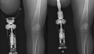 Більше ветеранів отримають якісне протезування: остеоінтеграція стане державною програмою
