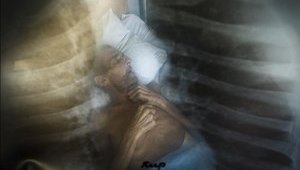 туберкулез