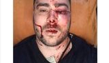 У Запоріжжі лідера "АвтоЄвроСили" Погорєлова побили і прострелили ногу через зауваження не кидати петарди. ФОТОрепортаж