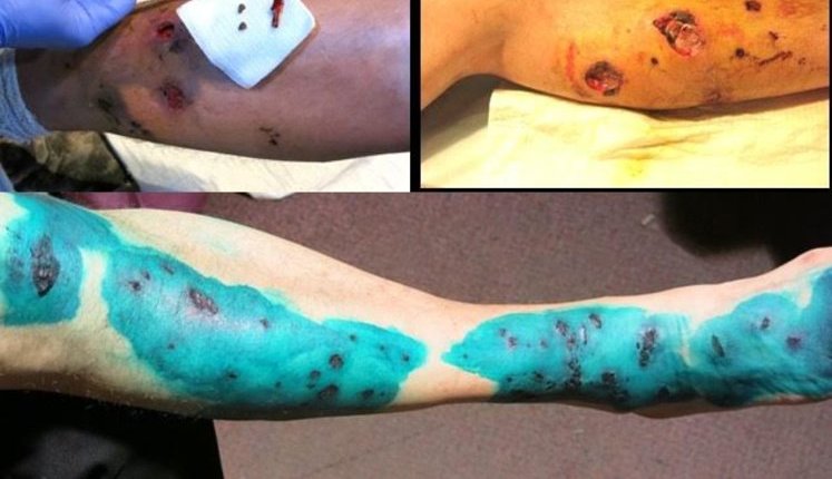 Special grenades were used to inflict grave injuries on Maidan protesters, - medical experts. PHOTOS